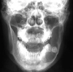 PA-mandible Radiograph